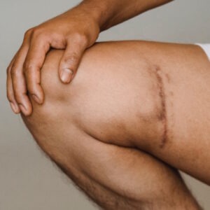 Eine Sportverletzung kann große Narben verursachen.