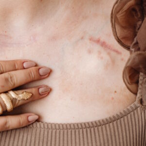 Im Halsbreich können Narben spannen und Schmerzen verursachen.